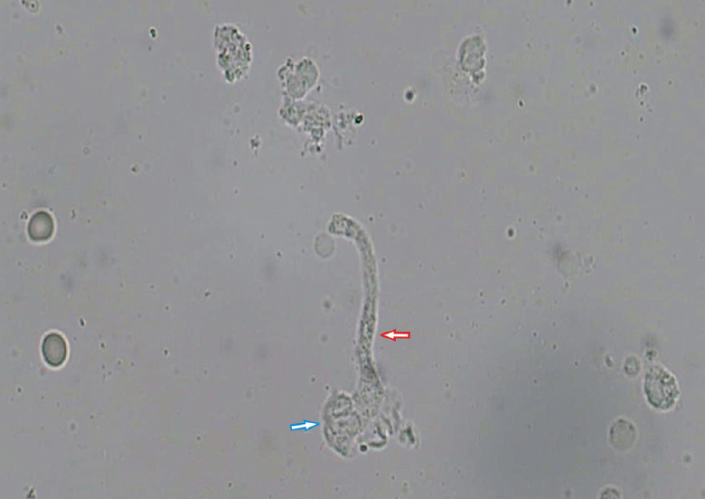 Urine routine microscopy showing the aseptate fungal hyphae (red arrow) with macrophages (blue arrow) and red blood cells (×400).